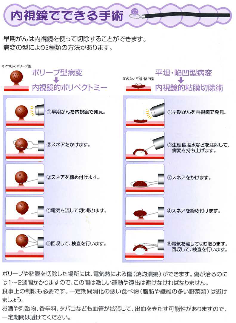 ポリペクトミーにより早期癌を治療しポリープからの発癌を予防