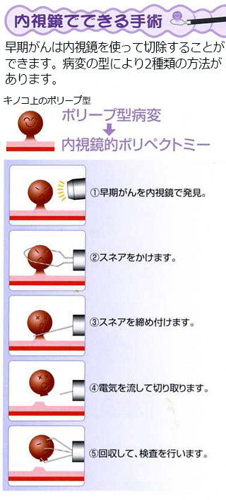 ポリペクトミーにより早期癌を治療しポリープからの発癌を予防