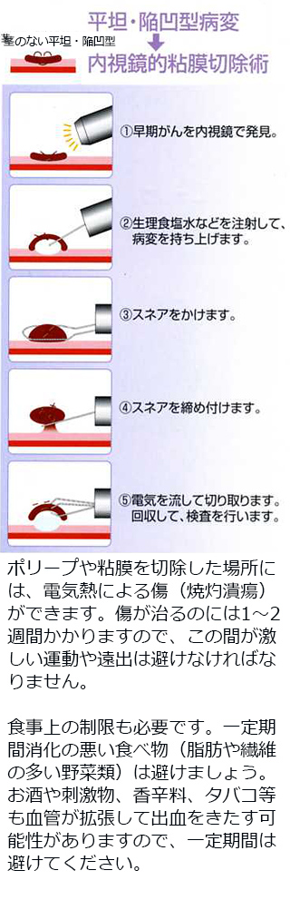 ポリペクトミーにより早期癌を治療しポリープからの発癌を予防